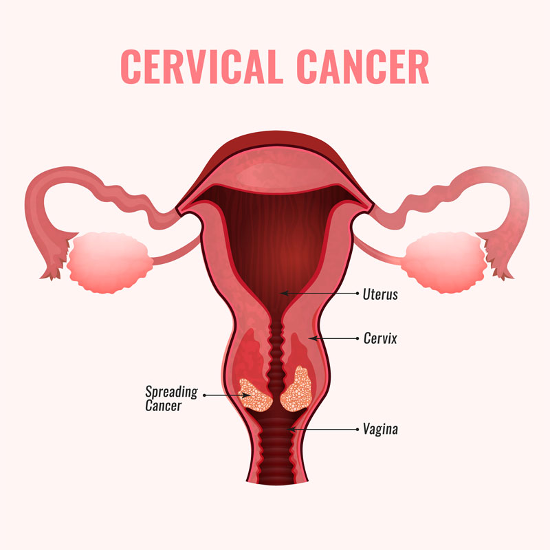 Cervical Cancer (HPV) Vaccination